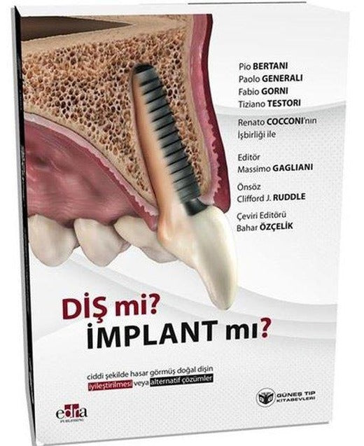 Diş mi? İmplant mı?
