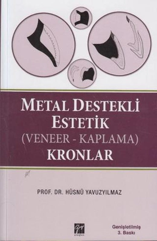 Metal Destekli Estetik (Veneer-Kaplama)Kronlar
