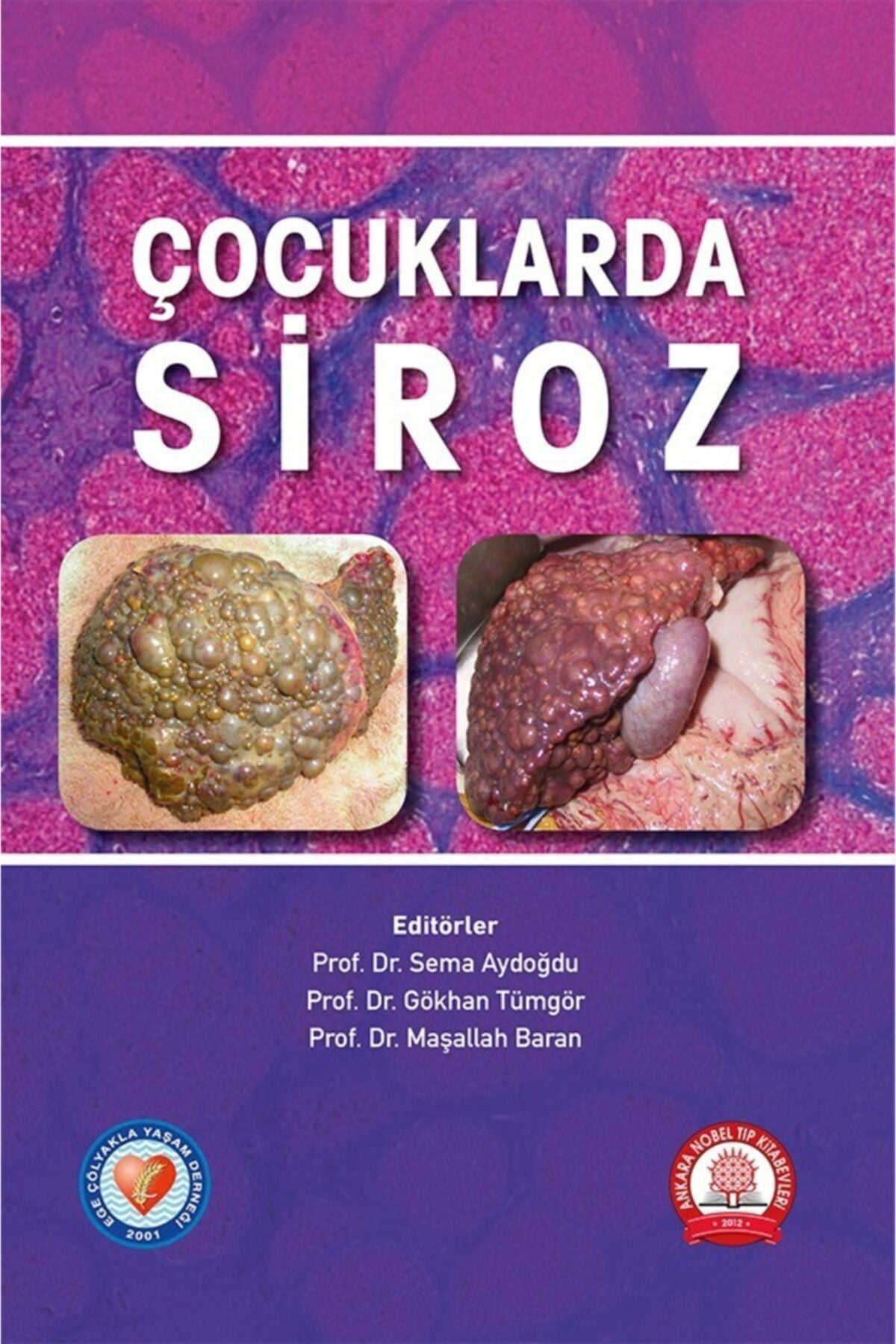 Çocuklarda Siroz - SEMA AYDOĞDU, GÖKGAN TÜMGÖR, MAŞALLAH BA kitap kapağı
