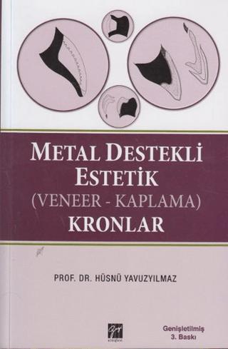 Metal Destekli Estetik (Veneer-Kaplama)Kronlar